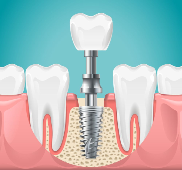 imagem de implante dentário